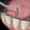 LINGUAL LIGATURE DIRECTOR / MDI-2005 - Image 4