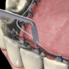 LINGUAL LIGATURE DIRECTOR / MDI-2005 - Image 3